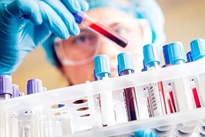 Blood test shows promise for detecting testicular cancer when standard markers miss